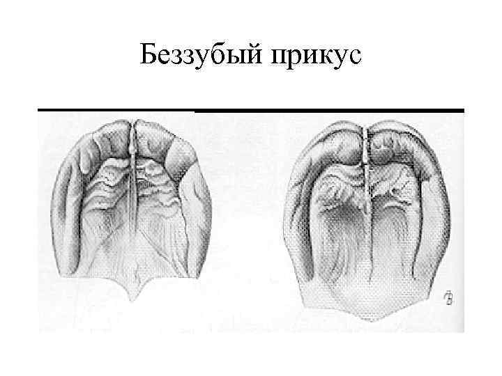 Беззубый прикус 