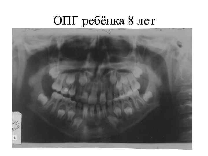 ОПГ ребёнка 8 лет 