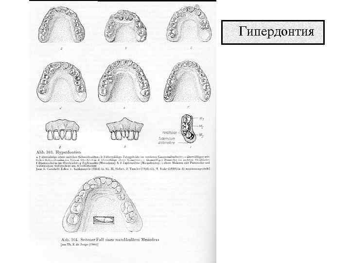 Гипердонтия 