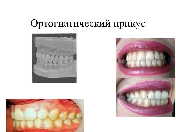 Опистогнатический прикус картинки