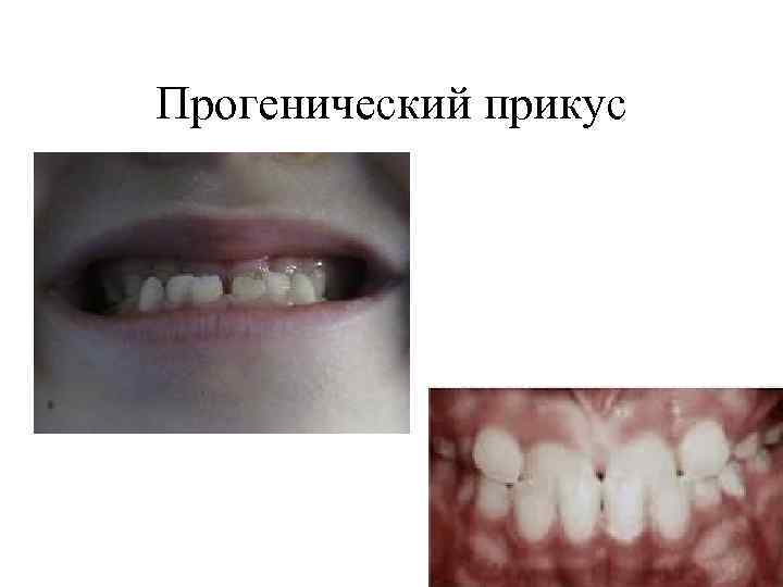 Прогенический прикус 