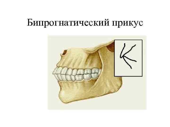 Бипрогнатический прикус 