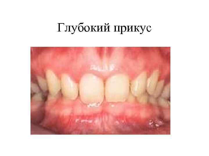 Глубокий прикус 