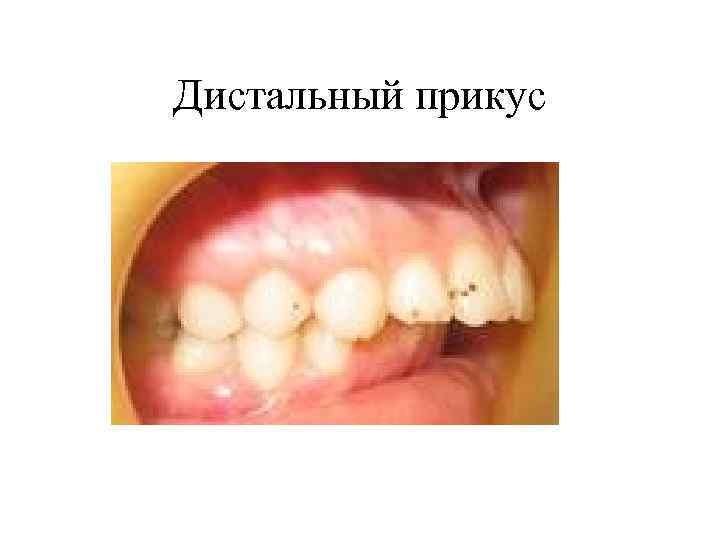 Дистальный прикус 