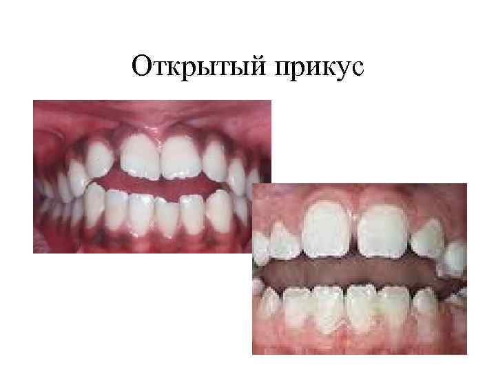 Открытый прикус 