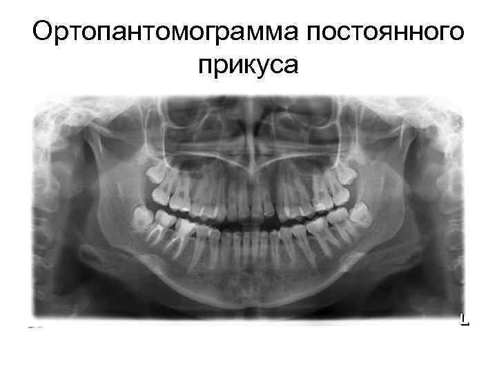 Ортопантомограмма постоянного прикуса 