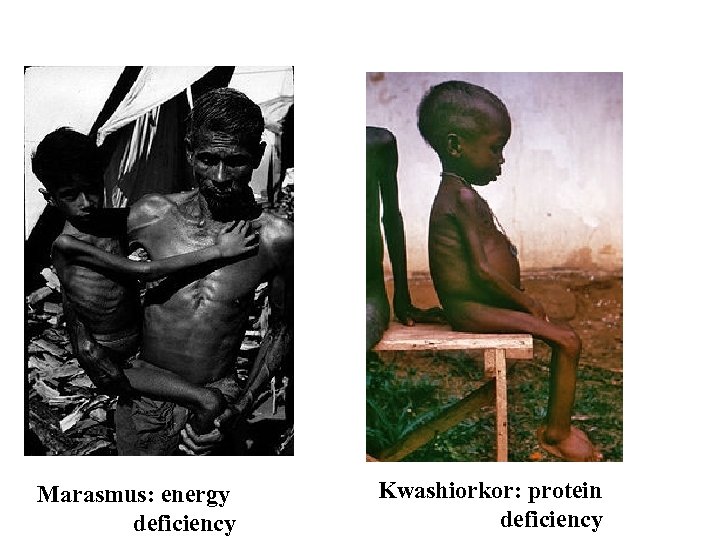 Marasmus: energy deficiency Kwashiorkor: protein deficiency 