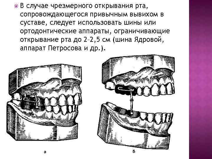  В случае чрезмерного открывания рта, сопровождающегося привычным вывихом в суставе, следует использовать шины