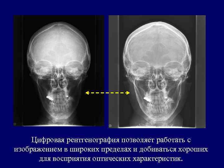 Цифровая рентгенография позволяет работать с изображением в широких пределах и добиваться хороших для восприятия