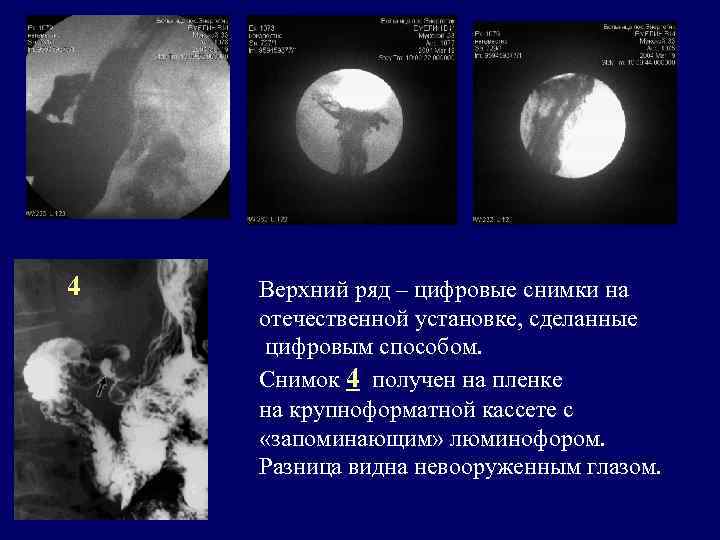 4 Верхний ряд – цифровые снимки на отечественной установке, сделанные цифровым способом. Снимок 4