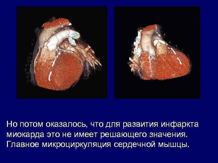 Но потом оказалось, что для развития инфаркта миокарда это не имеет решающего значения. Главное