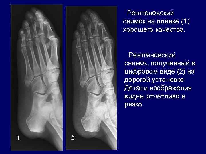 Рентгеновский снимок на пленке (1) хорошего качества. Рентгеновский снимок, полученный в цифровом виде (2)