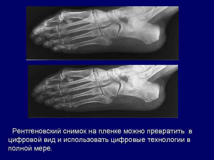 Рентгеновский снимок на пленке можно превратить в цифровой вид и использовать цифровые технологии в