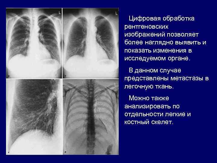 Цифровая обработка рентгеновских изображений позволяет более наглядно выявить и показать изменения в исследуемом органе.