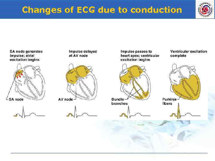 Changes of ECG due to conduction 