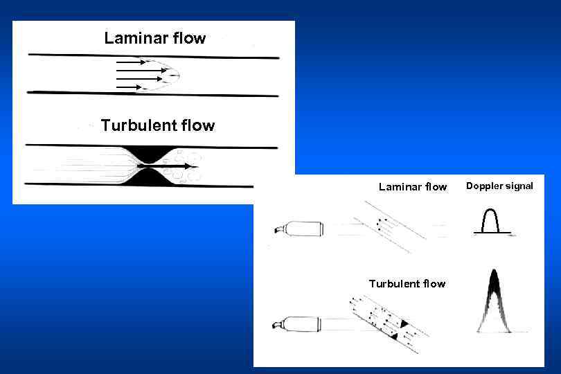 Laminar flow Turbulent flow Doppler signal 