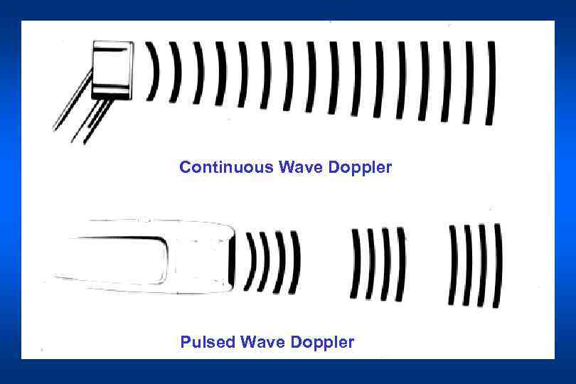 Continuous Wave Doppler Pulsed Wave Doppler 