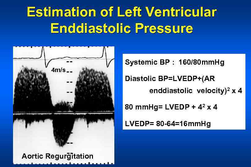 Estimation of Left Ventricular Enddiastolic Pressure Systemic BP : 160/80 mm. Hg 4 m/s