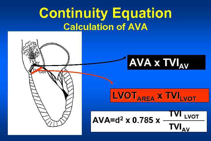 Continuity Equation Calculation of AVA x TVIAV LVOTAREA x TVILVOT TVI LVOT AVA=d 2