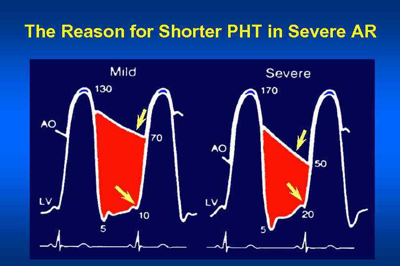 The Reason for Shorter PHT in Severe AR 