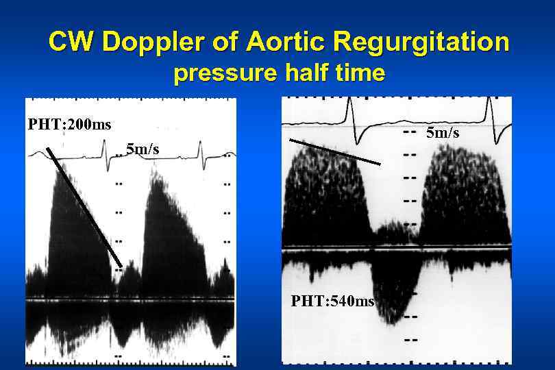 CW Doppler of Aortic Regurgitation pressure half time PHT: 200 ms 5 m/s PHT: