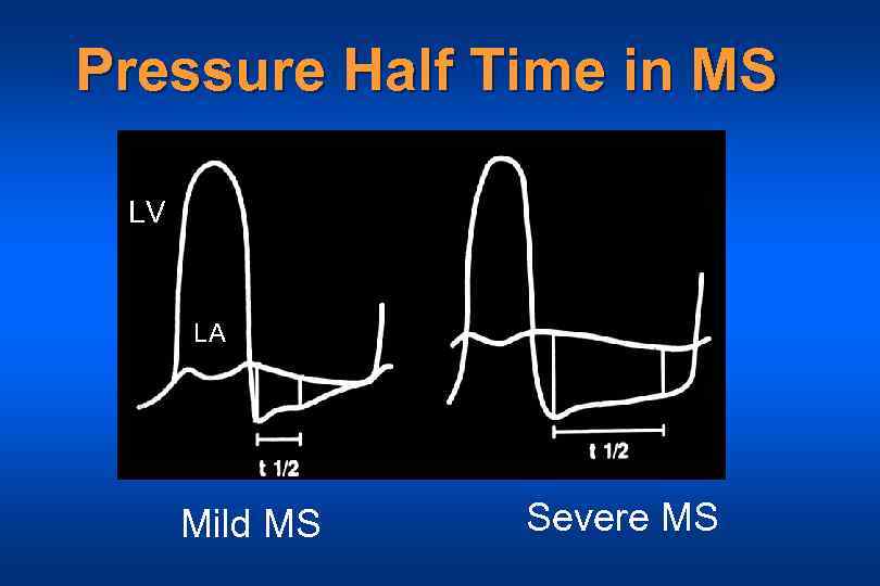 Pressure Half Time in MS LV LA Mild MS Severe MS 