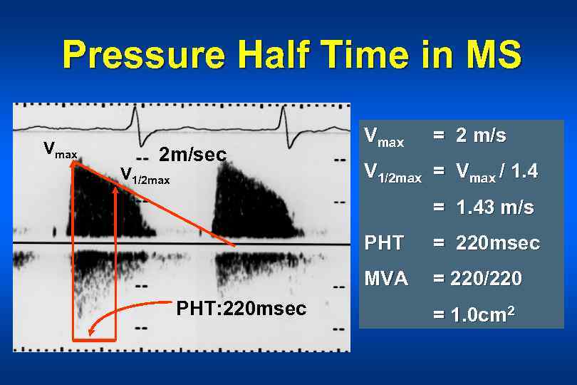 Pressure Half Time in MS Vmax 2 m/sec V 1/2 max Vmax = 2