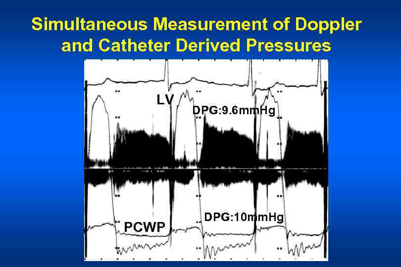 Simultaneous Measurement of Doppler and Catheter Derived Pressures LV PCWP DPG: 9. 6 mm.