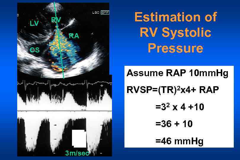 LV RV RA CS Estimation of RV Systolic Pressure Assume RAP 10 mm. Hg