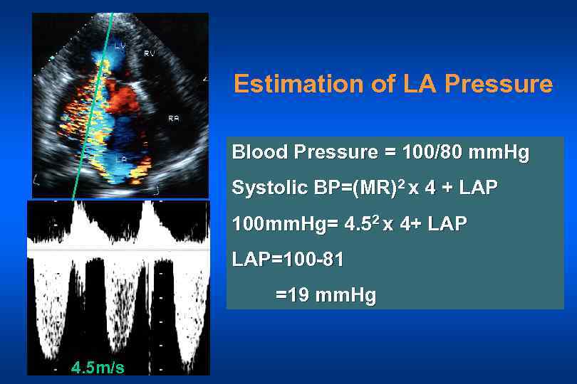 Estimation of LA Pressure Blood Pressure = 100/80 mm. Hg Systolic BP=(MR)2 x 4