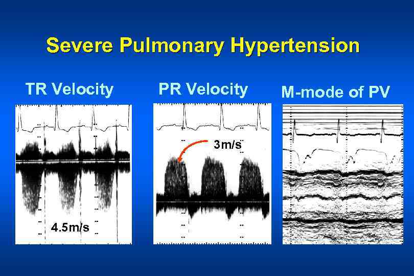 Severe Pulmonary Hypertension TR Velocity PR Velocity 3 m/s 4. 5 m/s M-mode of