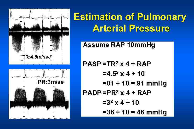 Estimation of Pulmonary Arterial Pressure Assume RAP 10 mm. Hg TR: 4. 5 m/sec