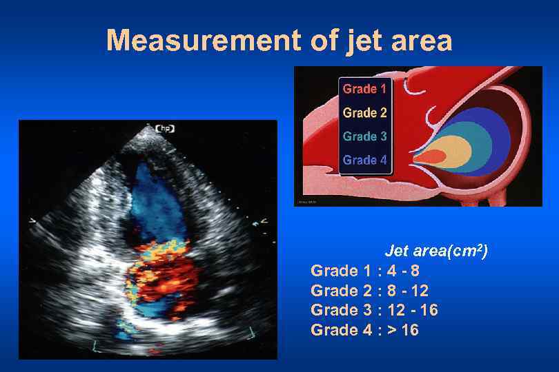 Measurement of jet area Jet area(cm 2) Grade 1 : 4 - 8 Grade