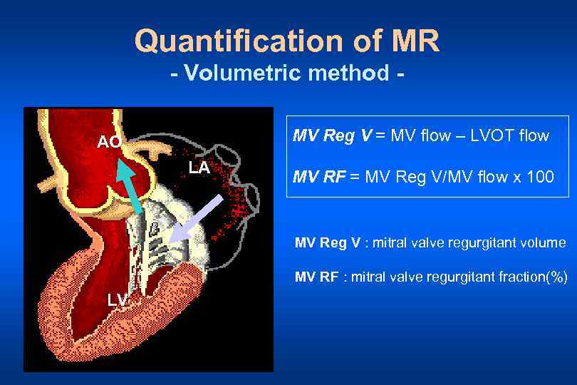 Quantification of MR - Volumetric method MV Reg V = MV flow – LVOT