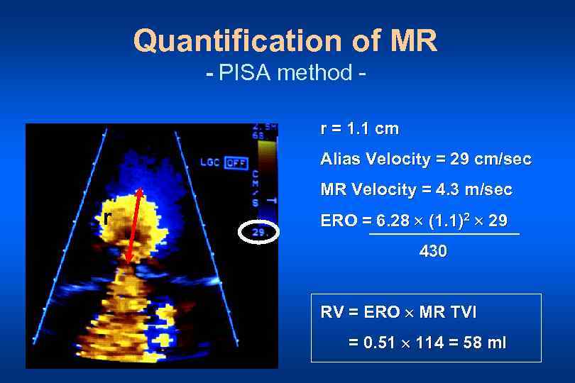 Quantification of MR - PISA method r = 1. 1 cm Alias Velocity =