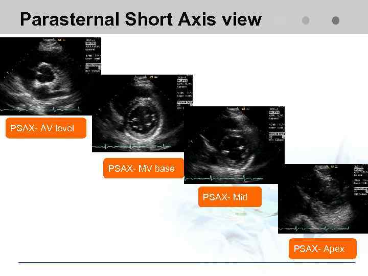Parasternal Short Axis view PSAX- AV level PSAX- MV base PSAX- Mid PSAX- Apex