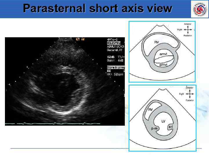 Parasternal short axis view 