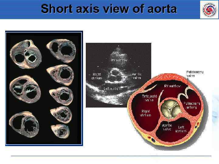 Short axis view of aorta 