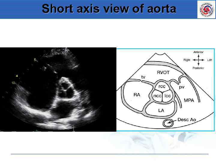 Short axis view of aorta 