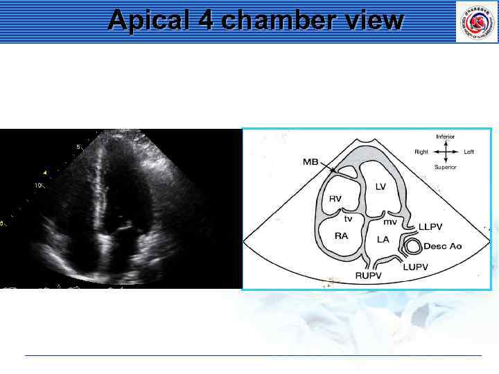 Apical 4 chamber view 