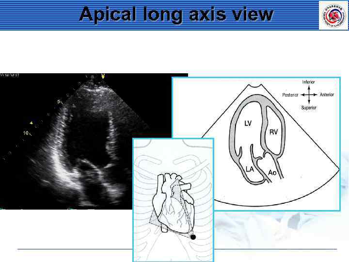Apical long axis view 