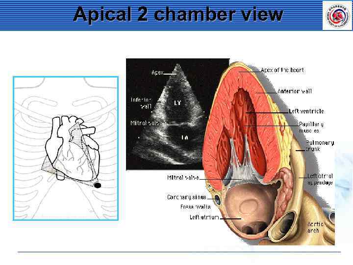 Apical 2 chamber view 