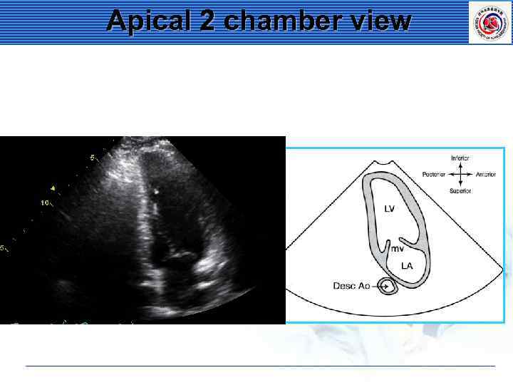 Apical 2 chamber view 