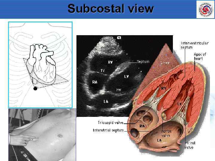 Subcostal view 