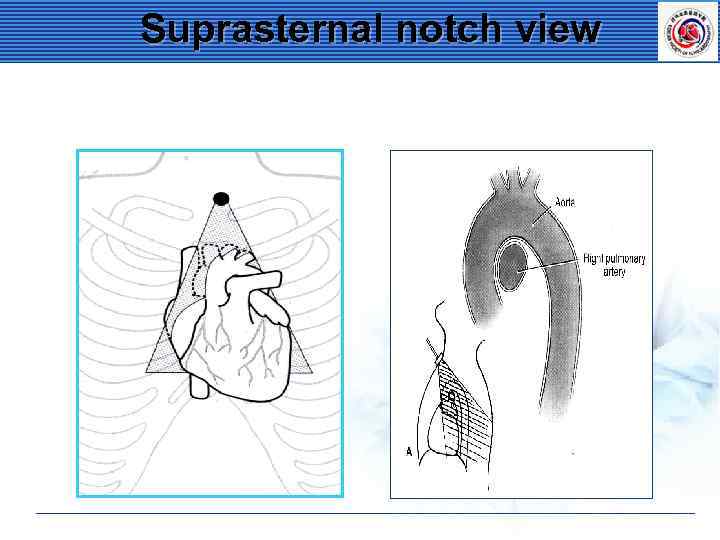 Suprasternal notch view 