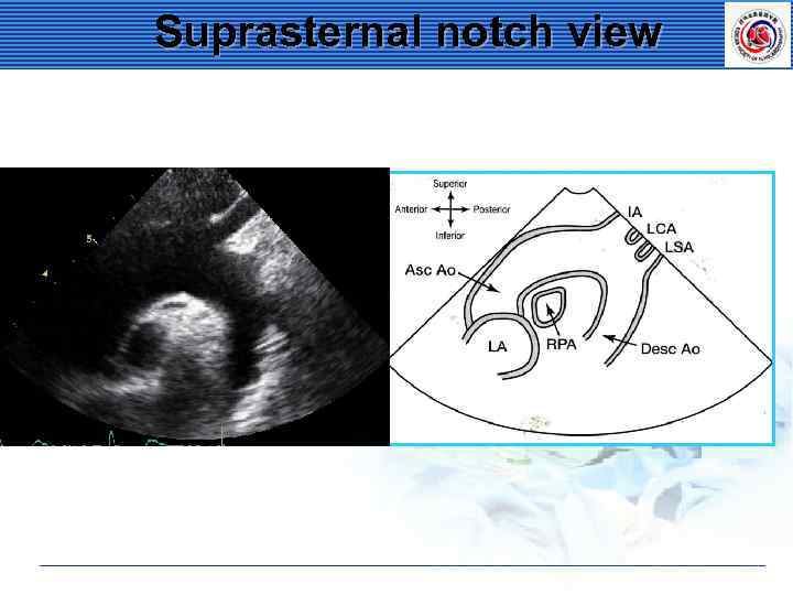 Suprasternal notch view 