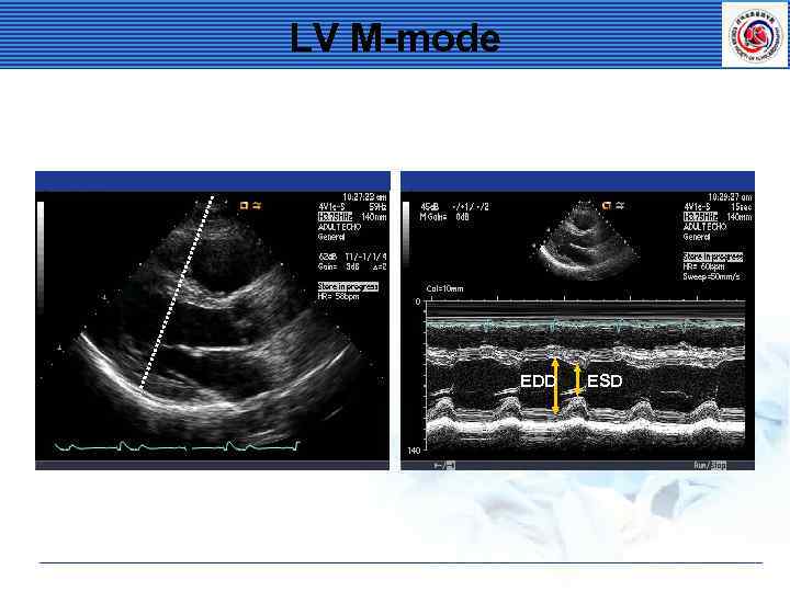 LV M-mode EDD ESD 