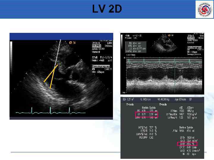 LV 2 D Oblique parasternal images를 피 한다. 