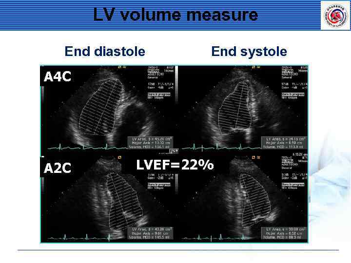 LV volume measure End diastole End systole A 4 C A 2 C LVEF=22%