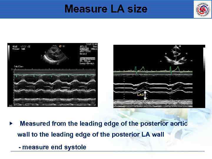 Measure LA size ▶ Measured from the leading edge of the posterior aortic wall